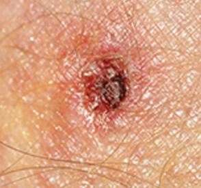 Tick Bite