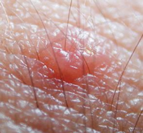 Mosquito Bite