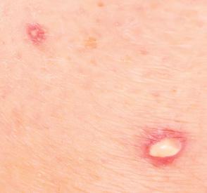 Ant Bite