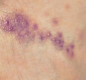 Scabies Bite
